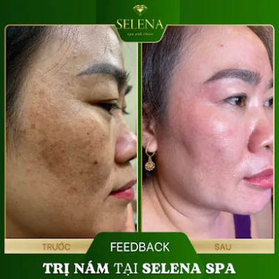 spa trị nám uy tín phan thiết - selena spa - spa mặt