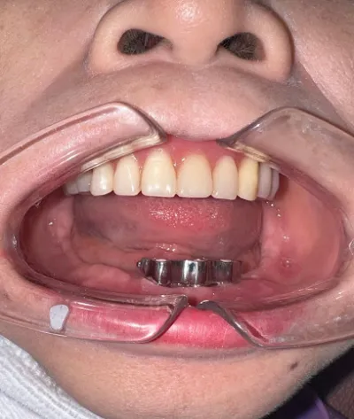 tiến implant  hỗ trợ cấy ghép implant nha khoa tại phòng khám - nha sĩ