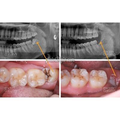 làm đẹp bình thạnh hồ chí minh | nhổ răng khôn bình...