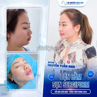 Làm Đẹp Quận 7 Hồ Chí Minh Độn Cằm Sụn Surgiform Làm Đẹp Quận 7 Hồ Chí Minh Độn Cằm Sụn Surgiform