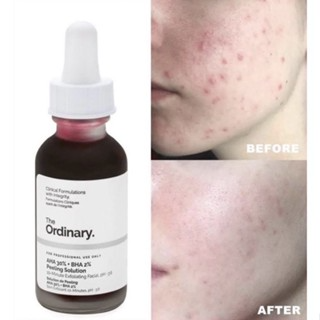 Tinh Chất Peel da The Ordinary AHA 30%BHA 2% Peeling Solution 30ml...