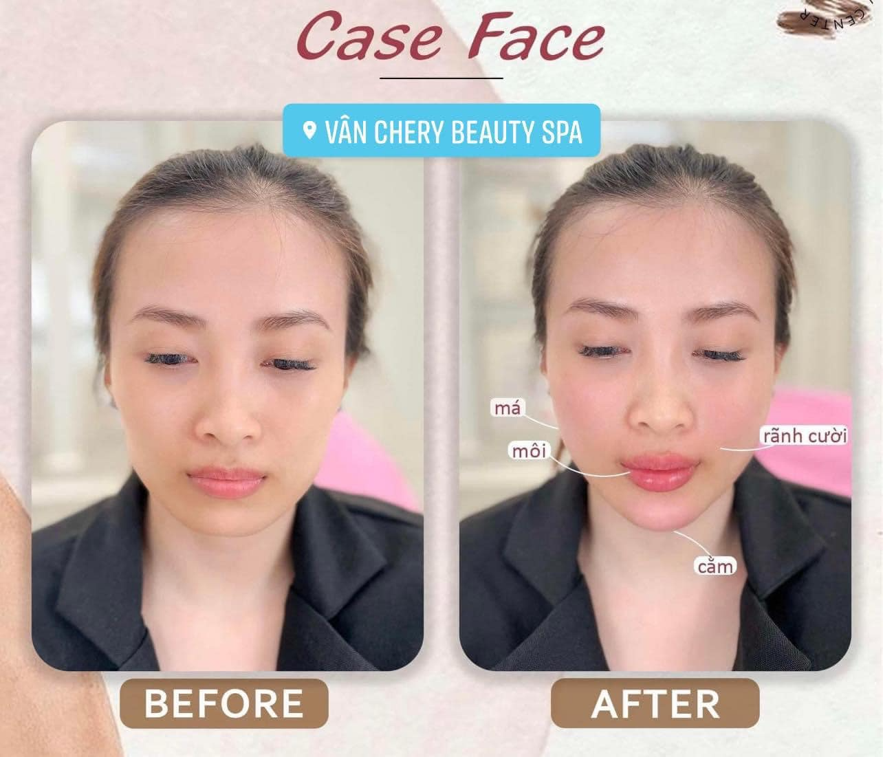 Điểm Danh 11 Địa Chỉ Tiêm Filler Nha Trang Uy Tín