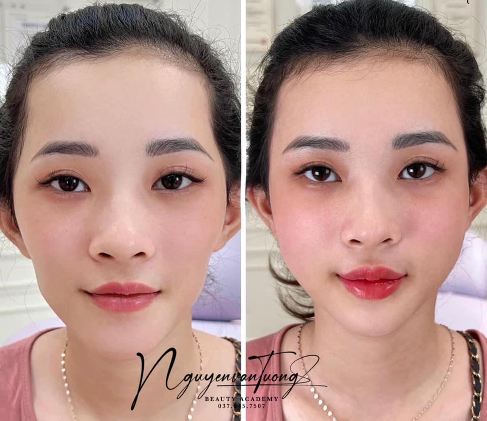 Điểm Danh 11 Địa Chỉ Tiêm Filler Nh...