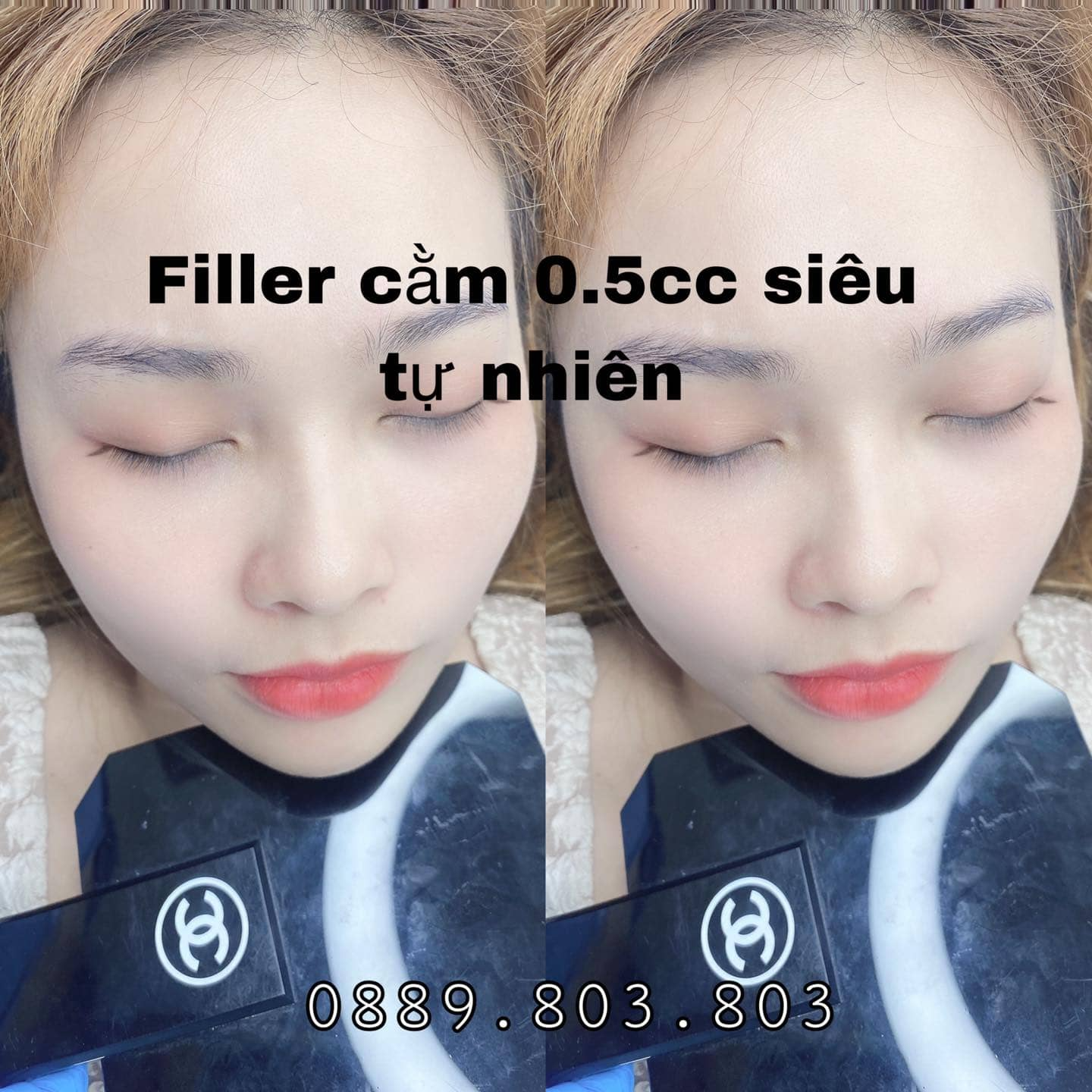 Điểm Danh 11 Địa Chỉ Tiêm Filler Nh...