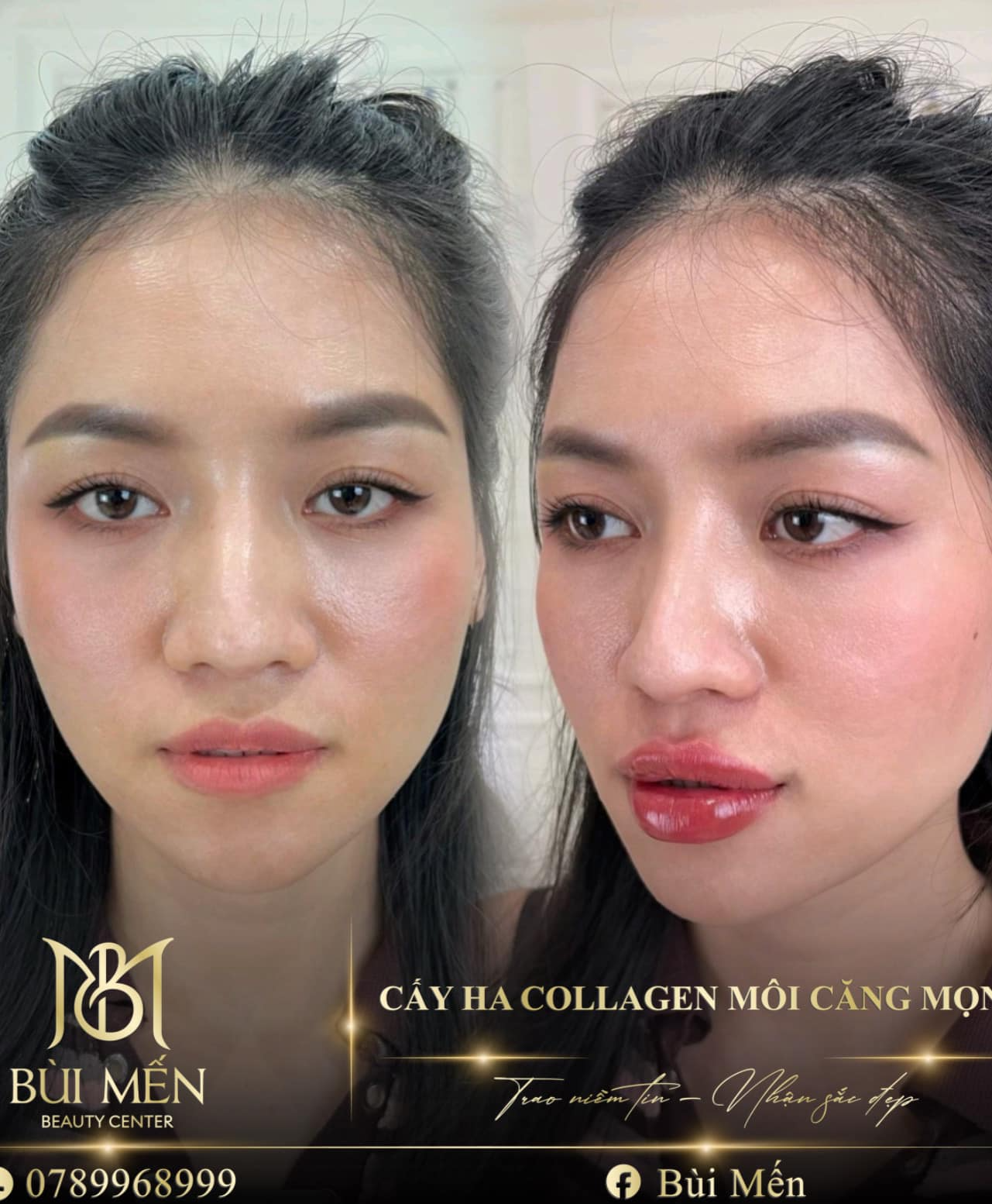 Điểm Danh 11 Địa Chỉ Tiêm Filler Nh...