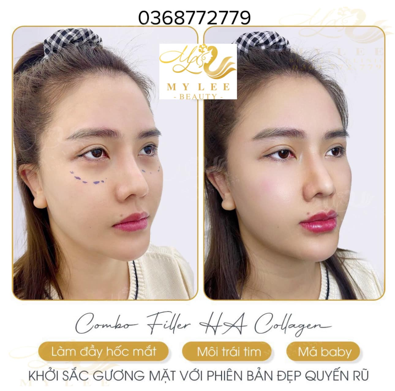 Điểm Danh 11 Địa Chỉ Tiêm Filler Nh...