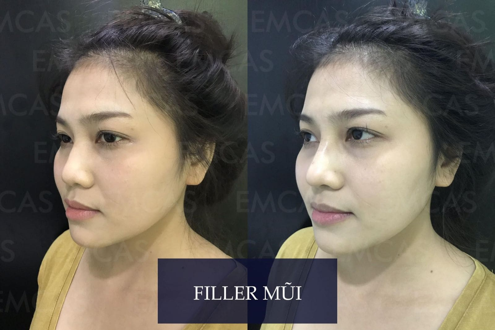 Top 10 Địa Chỉ Tiêm Filler Uy Tín H...