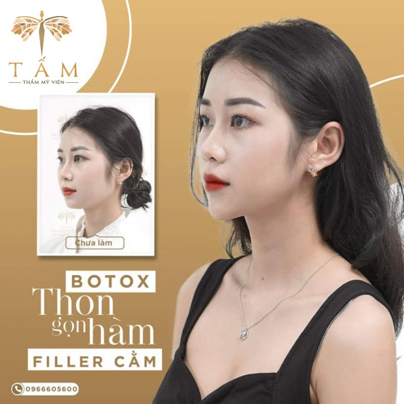 Top 10 Địa Chỉ Tiêm Filler Uy Tín H...