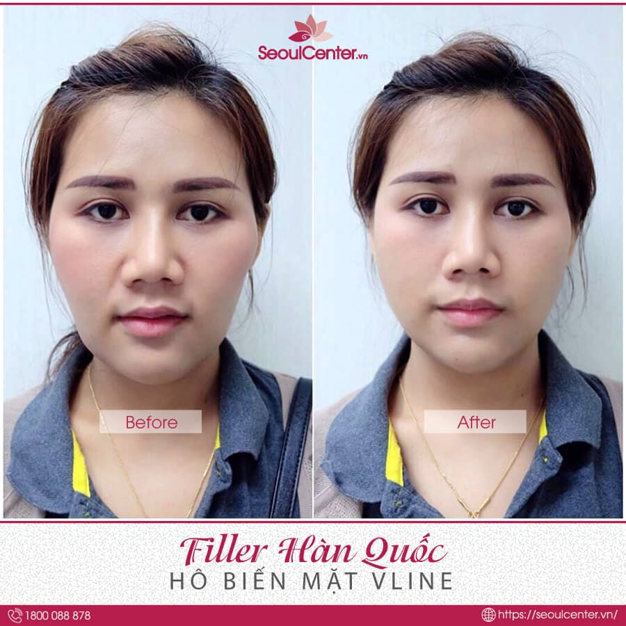 Top 10 Địa Chỉ Tiêm Filler Uy Tín Hà Nội Đảm Bảo An Toàn