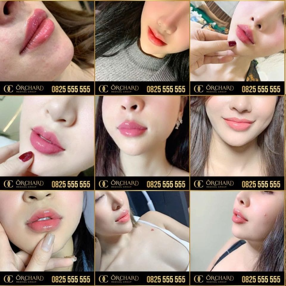 Top 10 Địa Chỉ Tiêm Filler Uy Tín H...