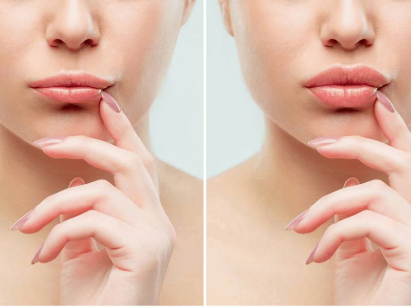 Top 10 Địa Chỉ Tiêm Filler Uy Tín H...